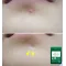 Acne stickers, night acne stickers, fade acne marks — photo 5 of 5